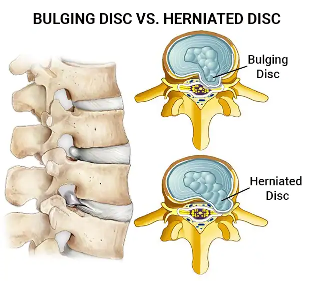 Bulging disc chiropractor in Tulsa showing disc anatomy and how chiropractic treatment restores spinal function